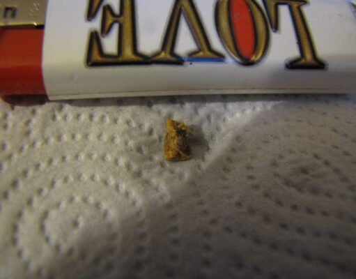 Sudden Hearing Loss: Warning Signs and When to Get Urgent Care Earwax removed from an ear