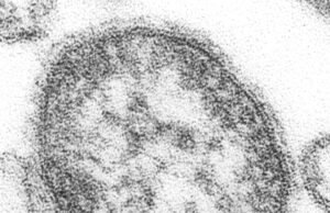 US Measles Cases 2026: Why the Count Is Higher Than All of 2025 Measles virus particles, CDC image (public domain via Wikimedia Commons)