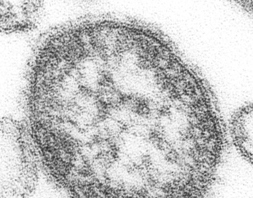 US Measles Cases 2026: Why the Count Is Higher Than All of 2025 Measles virus particles, CDC image (public domain via Wikimedia Commons)